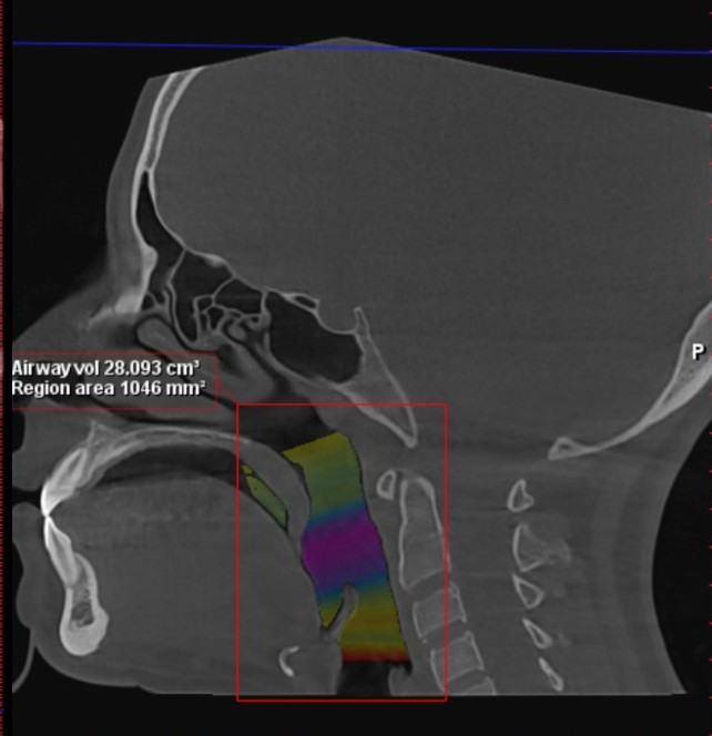 Patient airway volume, after, on 3D CBCT