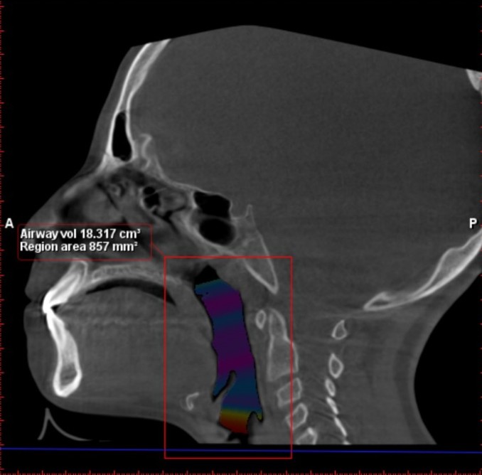 Patient airway volume, before, on 3D CBCT