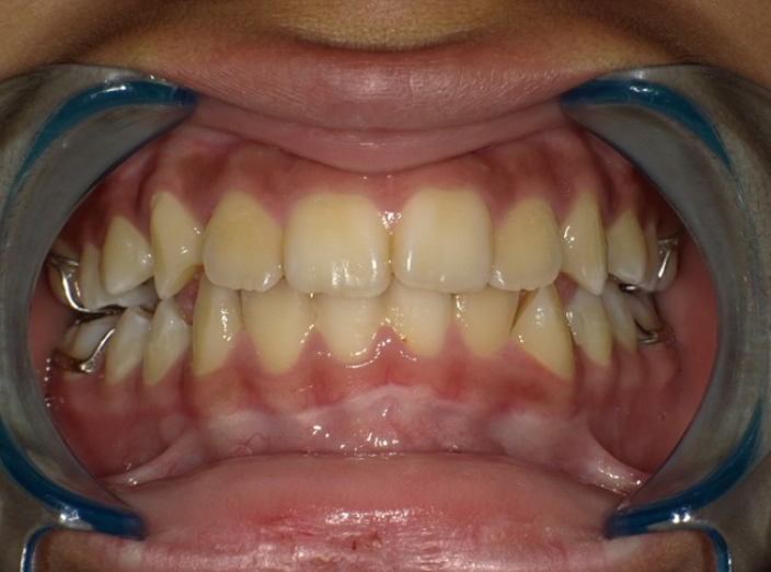 De-identified intraoral photo, after, showing a widened, more aligned arch