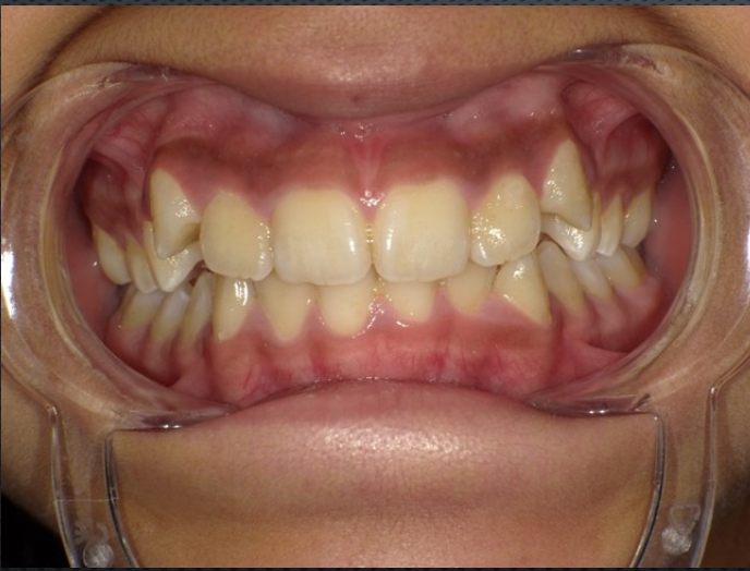 De-identified intraoral photo, before, showing a crowded dental arch and bite