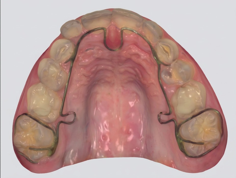 Upper dental arch on a 3D intraoral scan, before redevelopment